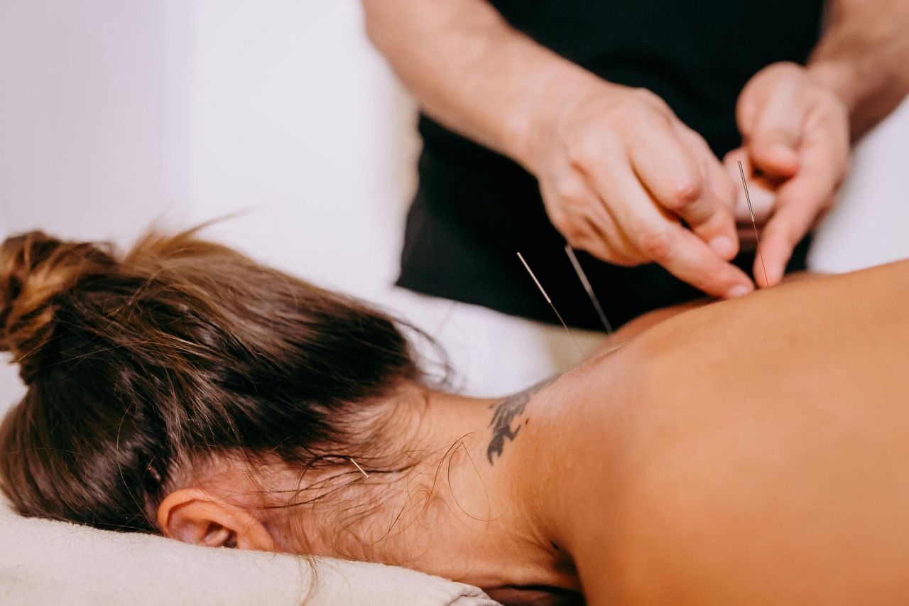Beneficios de la Acupuntura en el Tratamiento para Hiperhidrosis