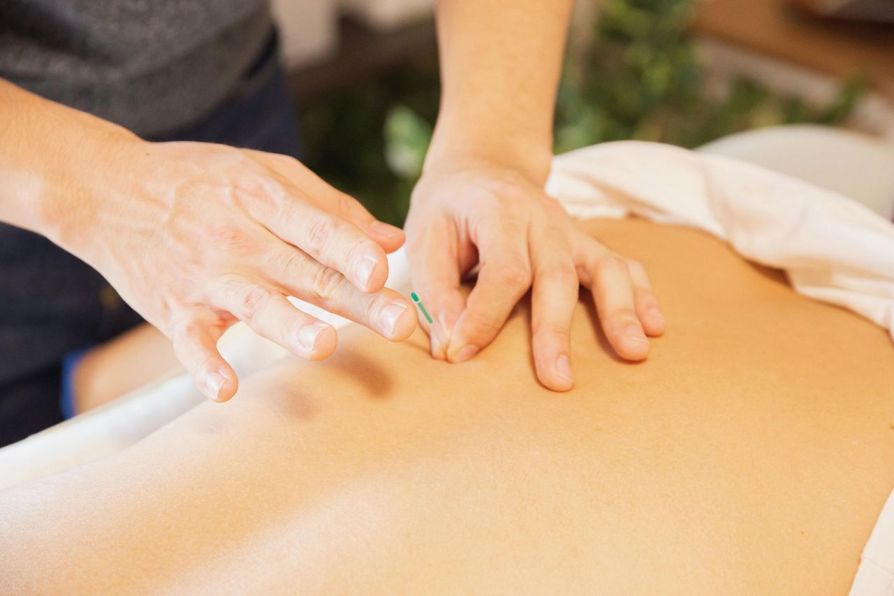 Acupuntura en Alcobendas: Bienestar y Equilibrio