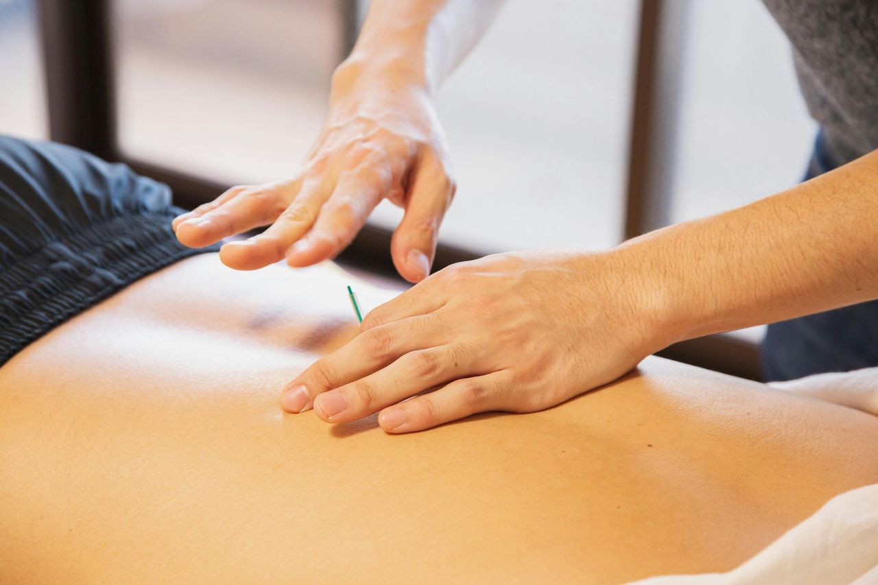 Acupuntura para Hiperhidrosis en Alcobendas: Tratamientos Naturales Efectivos